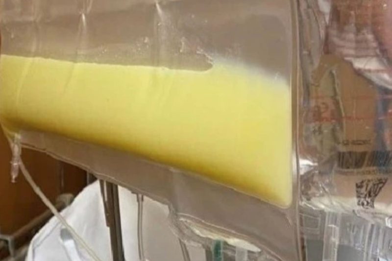 Tưởng đau bụng thông thường ai ngờ viêm tụy cấp vì thói quen đàn ông Việt thường làm